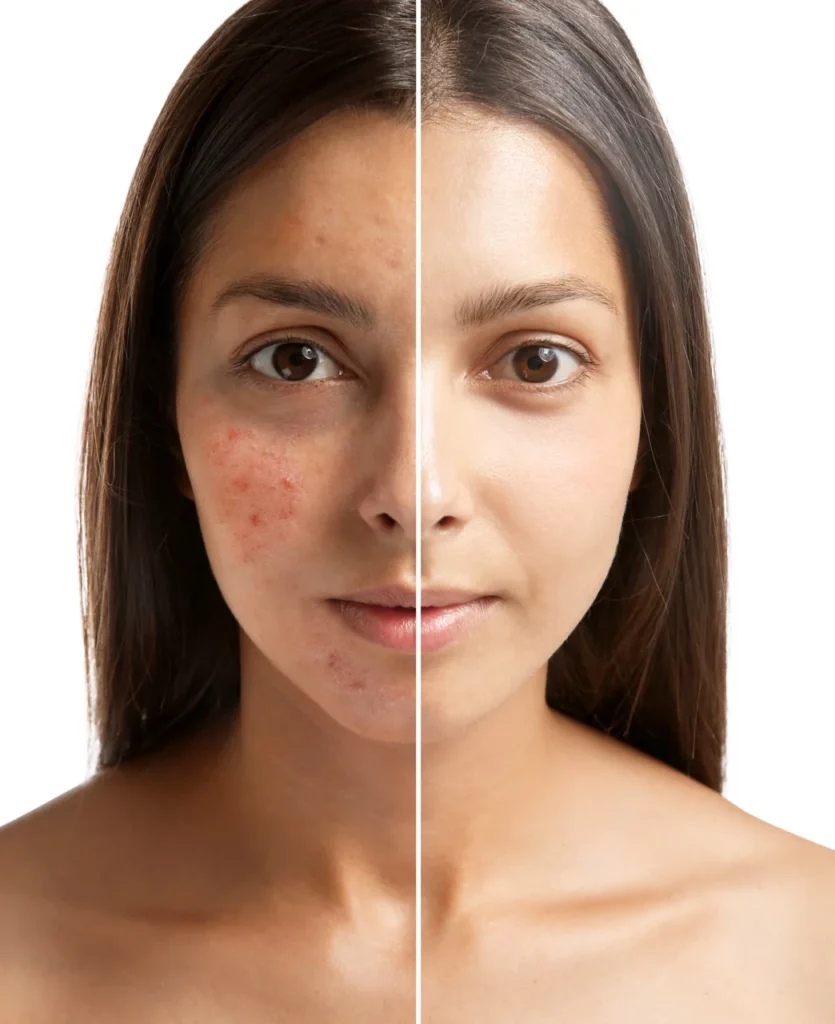 laser acne treatment before and after