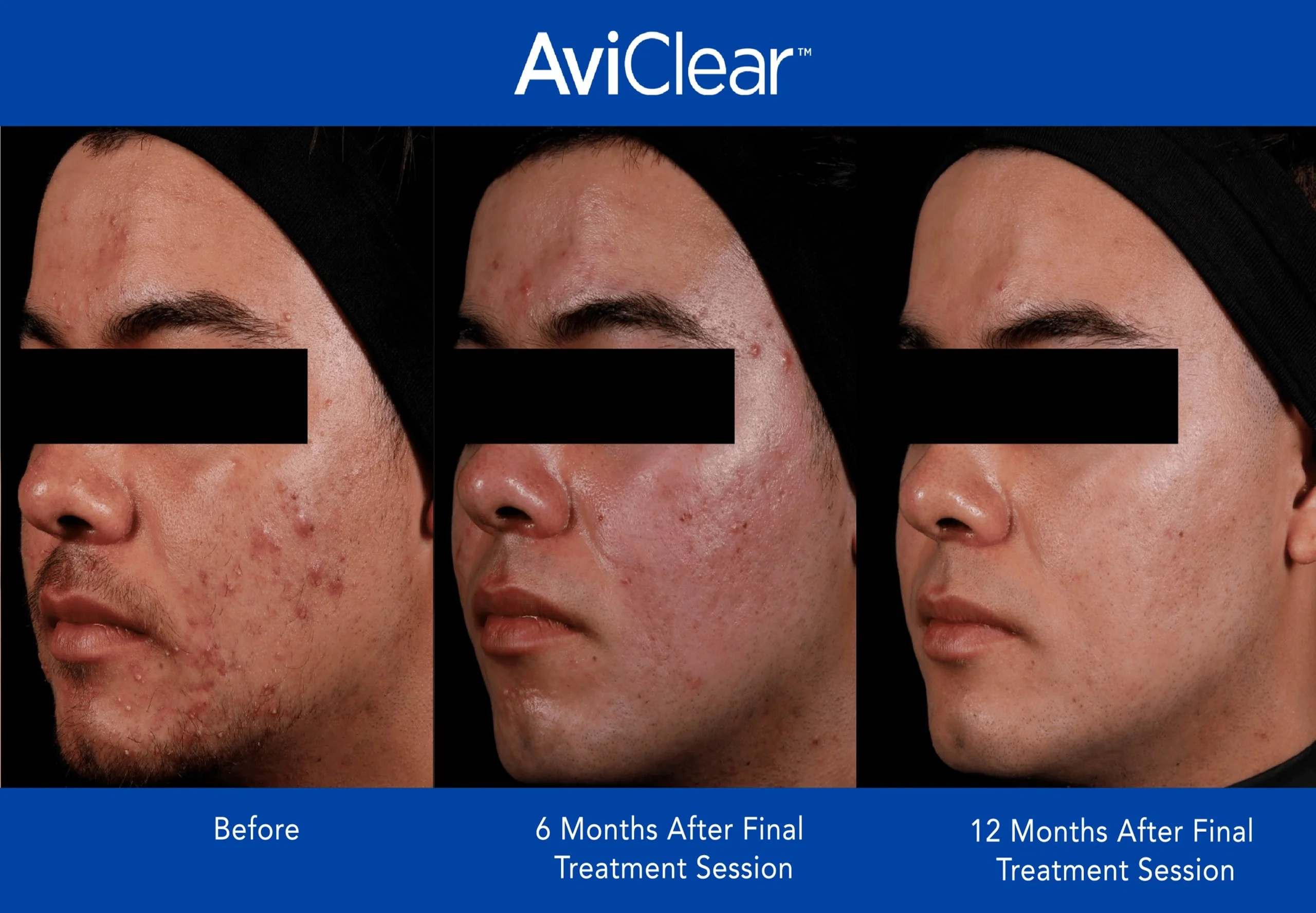 AviClear-Before-and-After-Live-Vibrant-Wellness-and-Aesthetics-in-Boynton-Beach-FL