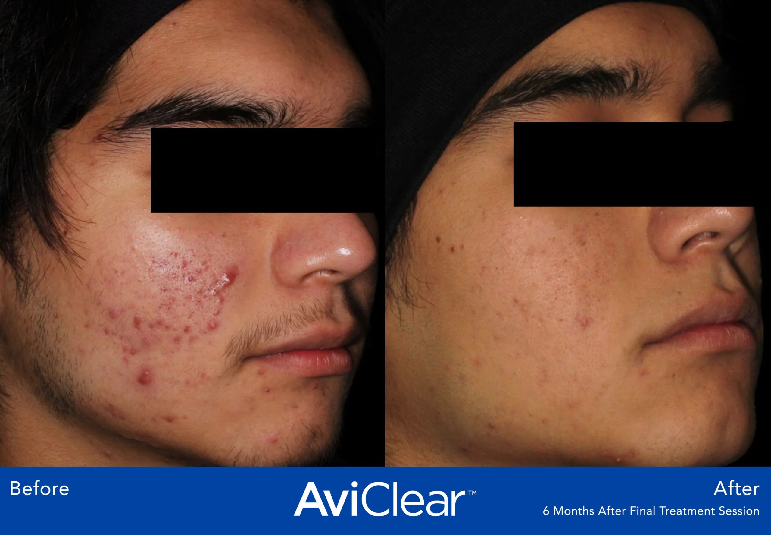 AviClear-Before-and-After-final-Live-Vibrant-Wellness-and-Aesthetics-in-Boynton-Beach-FL