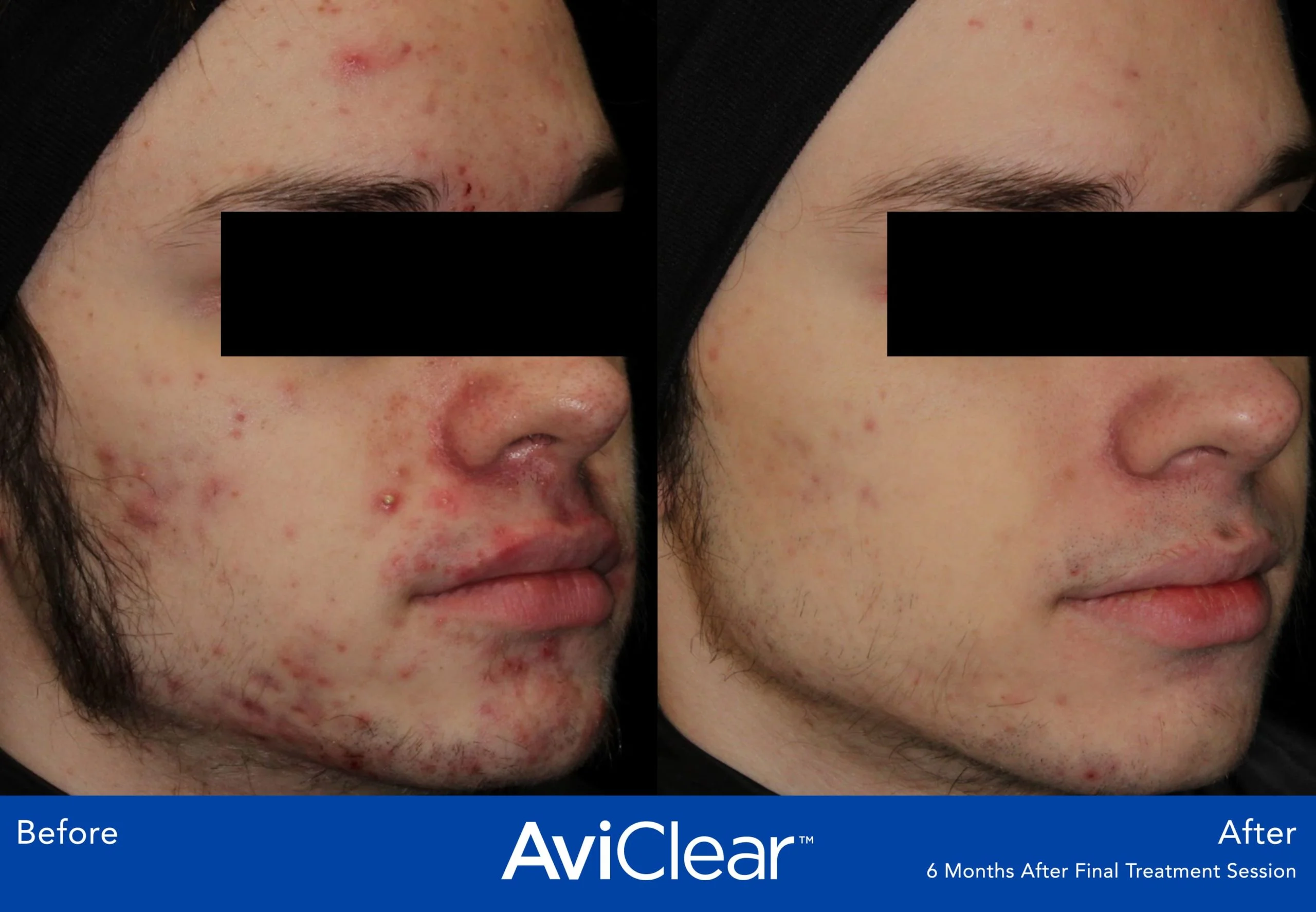 AviClear-Before-and-After-month-session-Live-Vibrant-Wellness-and-Aesthetics-in-Boynton-Beach-FL
