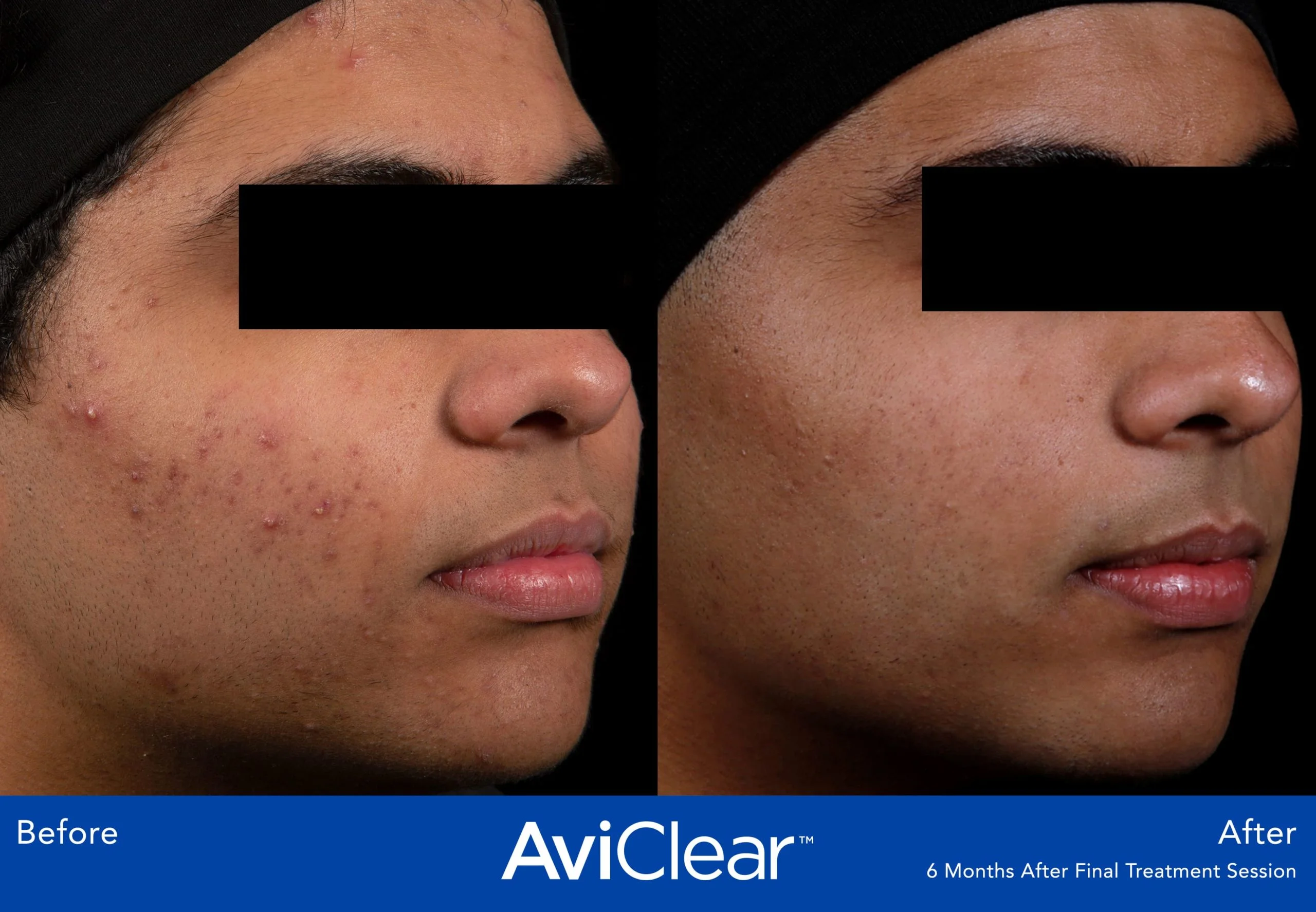 AviClear-Before-and-After-six-Live-Vibrant-Wellness-and-Aesthetics-in-Boynton-Beach-FL