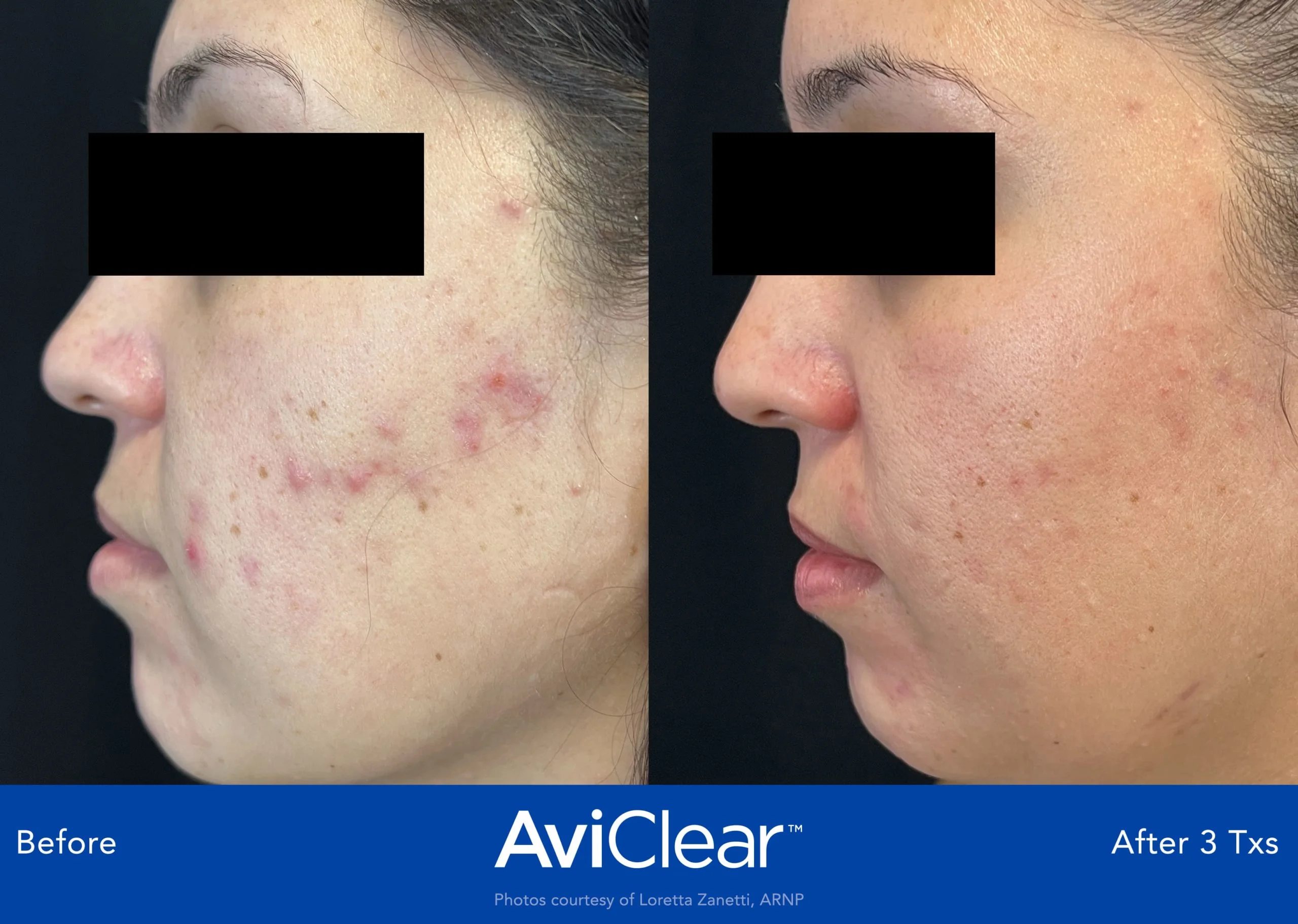 AviClear-Before-and-After-three-Live-Vibrant-Wellness-and-Aesthetics-in-Boynton-Beach-FL