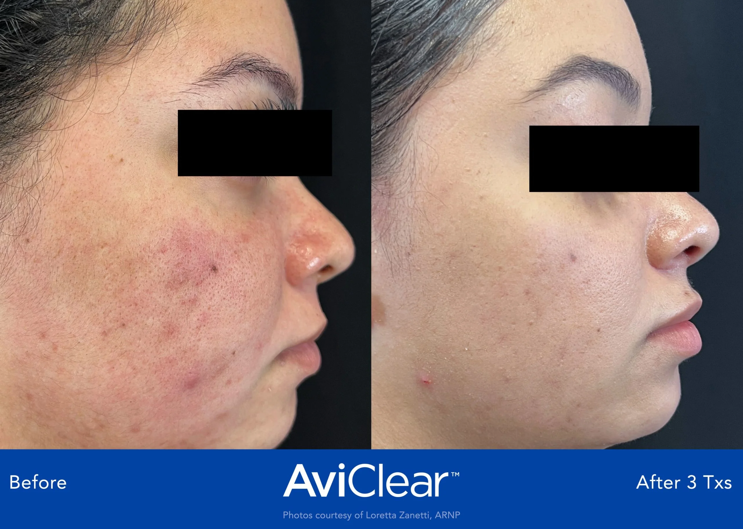 AviClear-Before-and-After-three-txs-Live-Vibrant-Wellness-and-Aesthetics-in-Boynton-Beach-FL