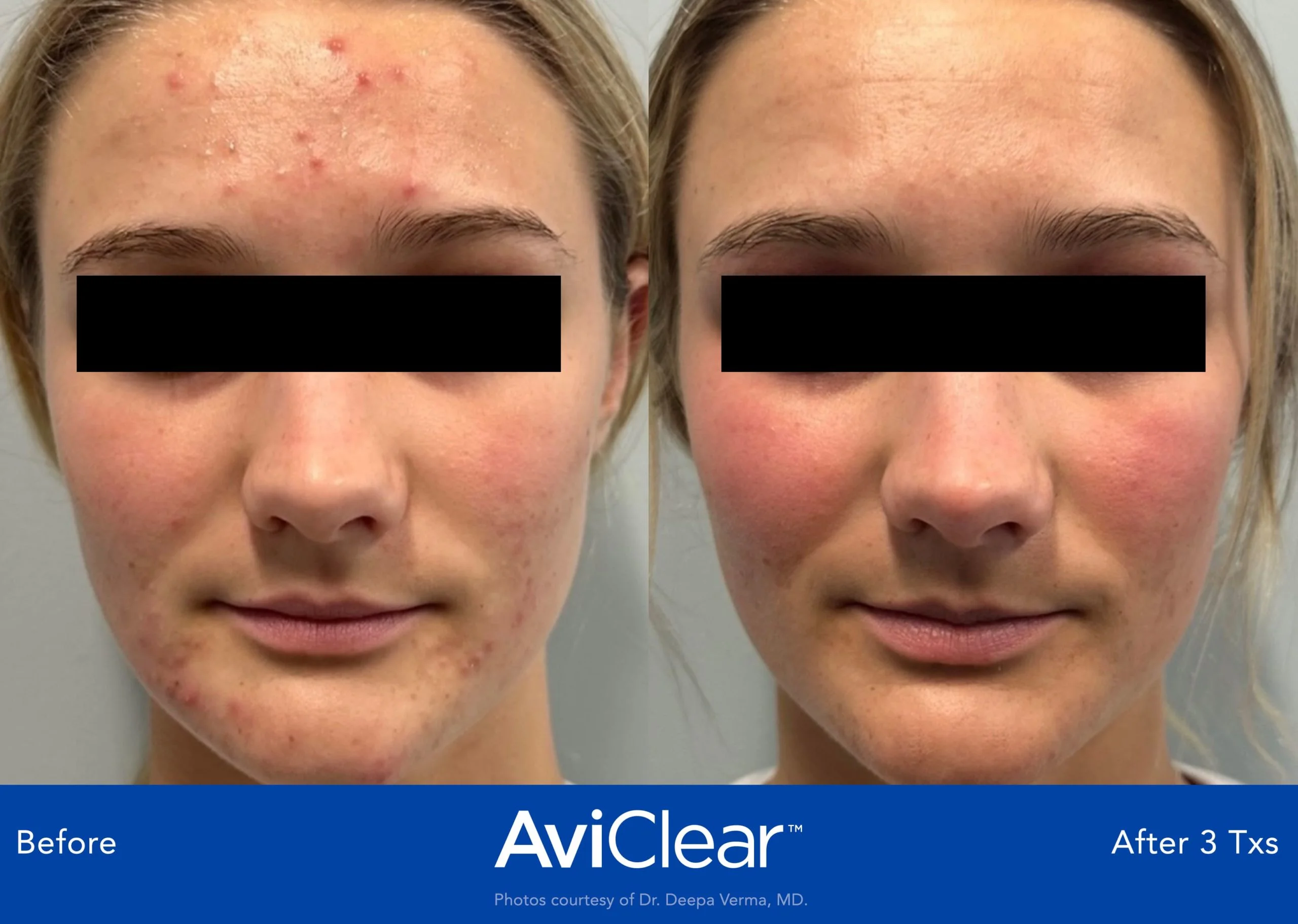 AviClear-Before-and-After-three-years-Live-Vibrant-Wellness-and-Aesthetics-in-Boynton-Beach-FL
