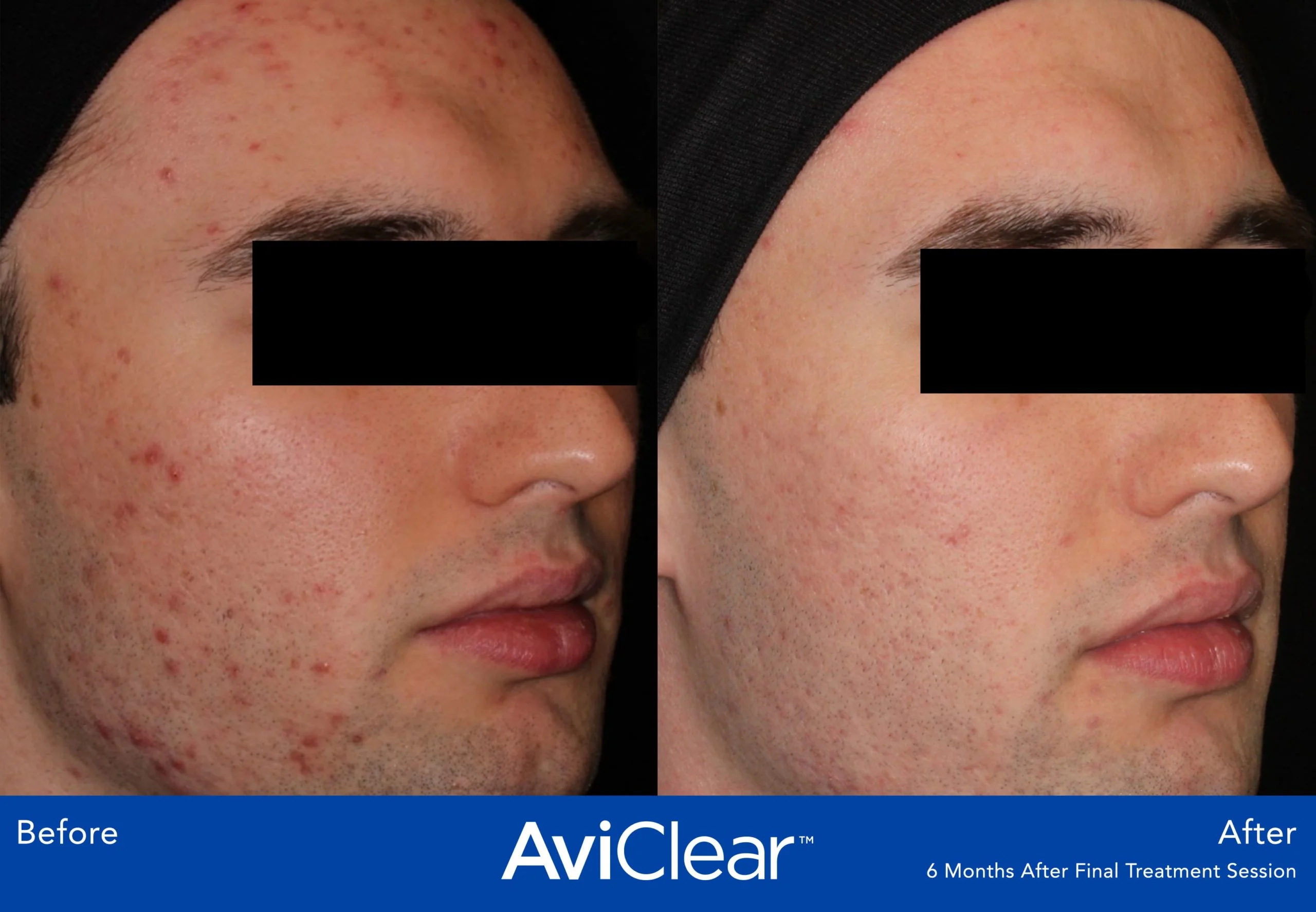 AviClear-Before-and-After-treatment-Live-Vibrant-Wellness-and-Aesthetics-in-Boynton-Beach-FL
