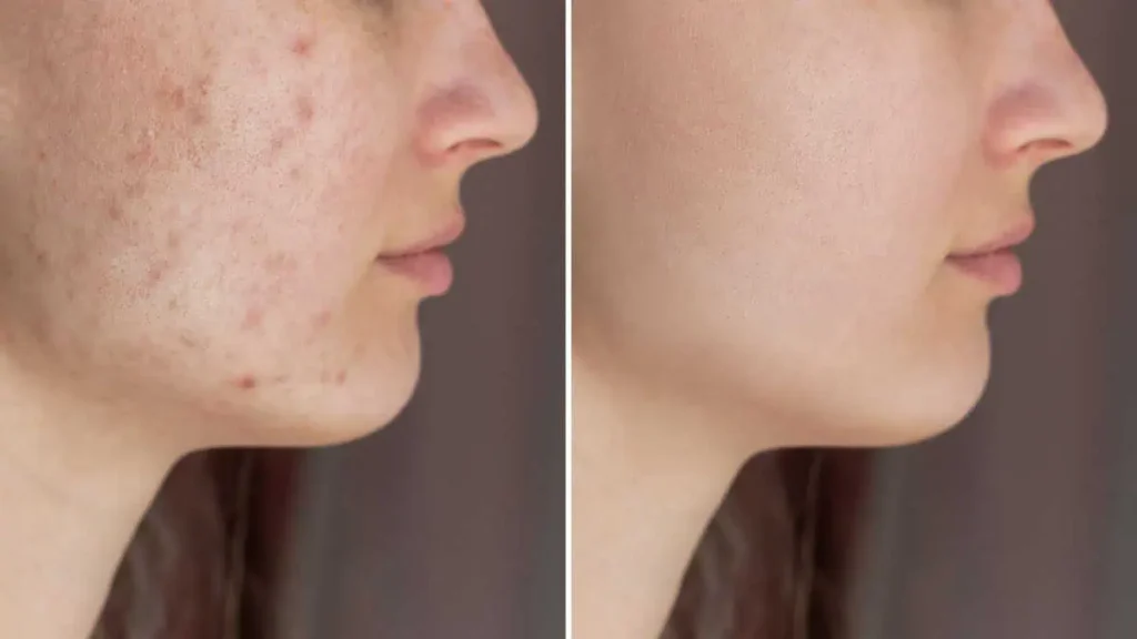 Aviclear acne Treatment Live Vibrant Wellness And Aesthetics