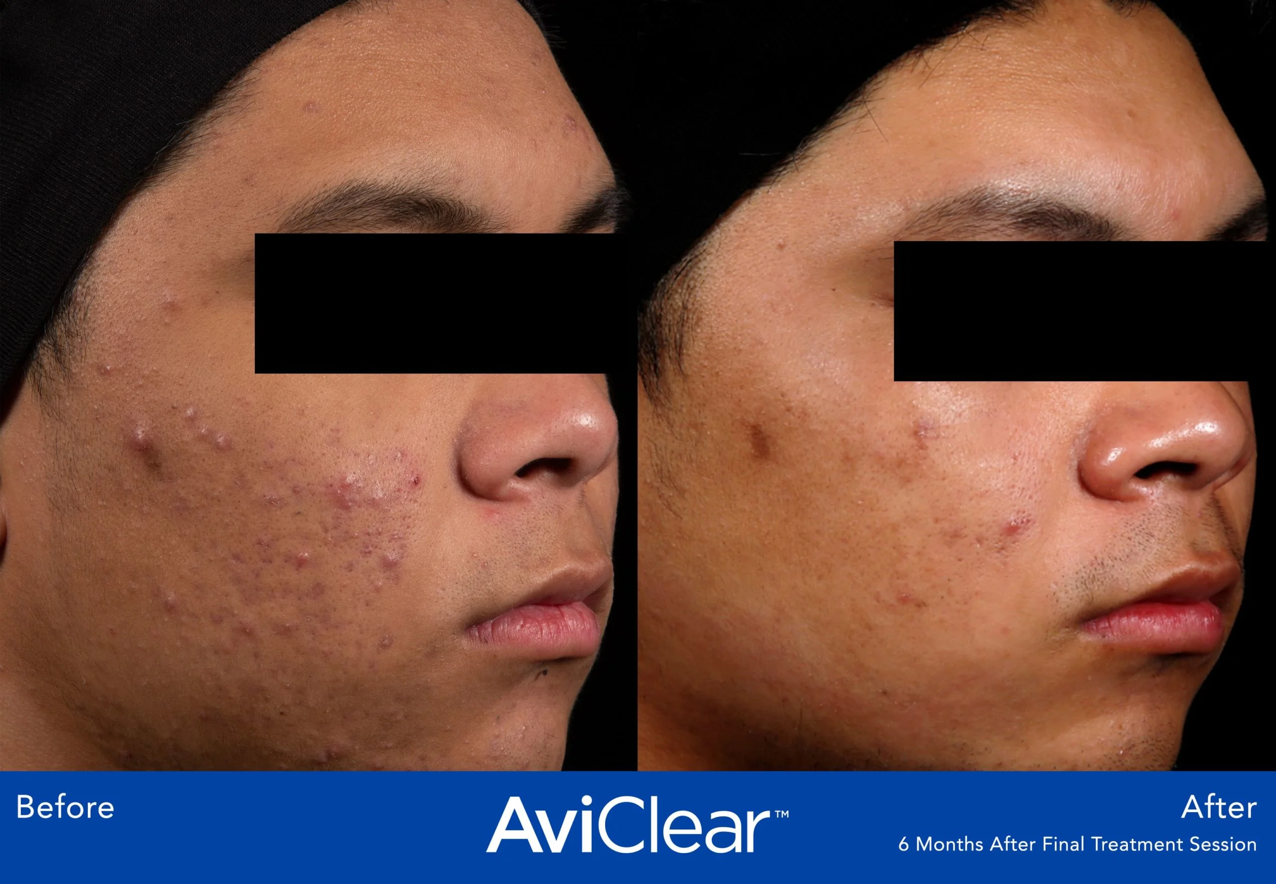 AviClear-Before-and-After-final-treatment-Live-Vibrant-Wellness-and-Aesthetics-in-Boynton-Beach-FL