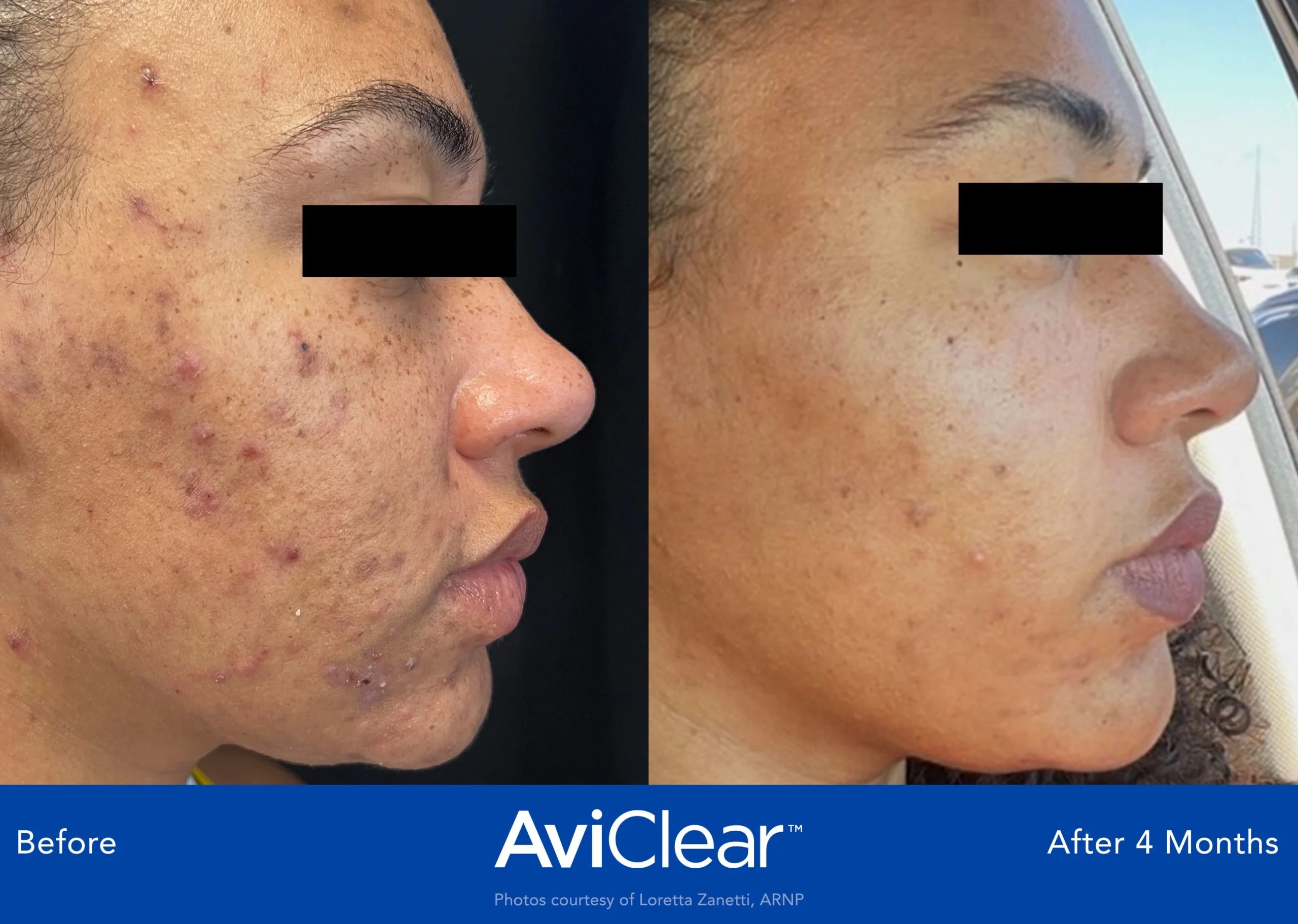 AviClear-Before-and-After-four-month-Live-Vibrant-Wellness-and-Aesthetics-in-Boynton-Beach-FL