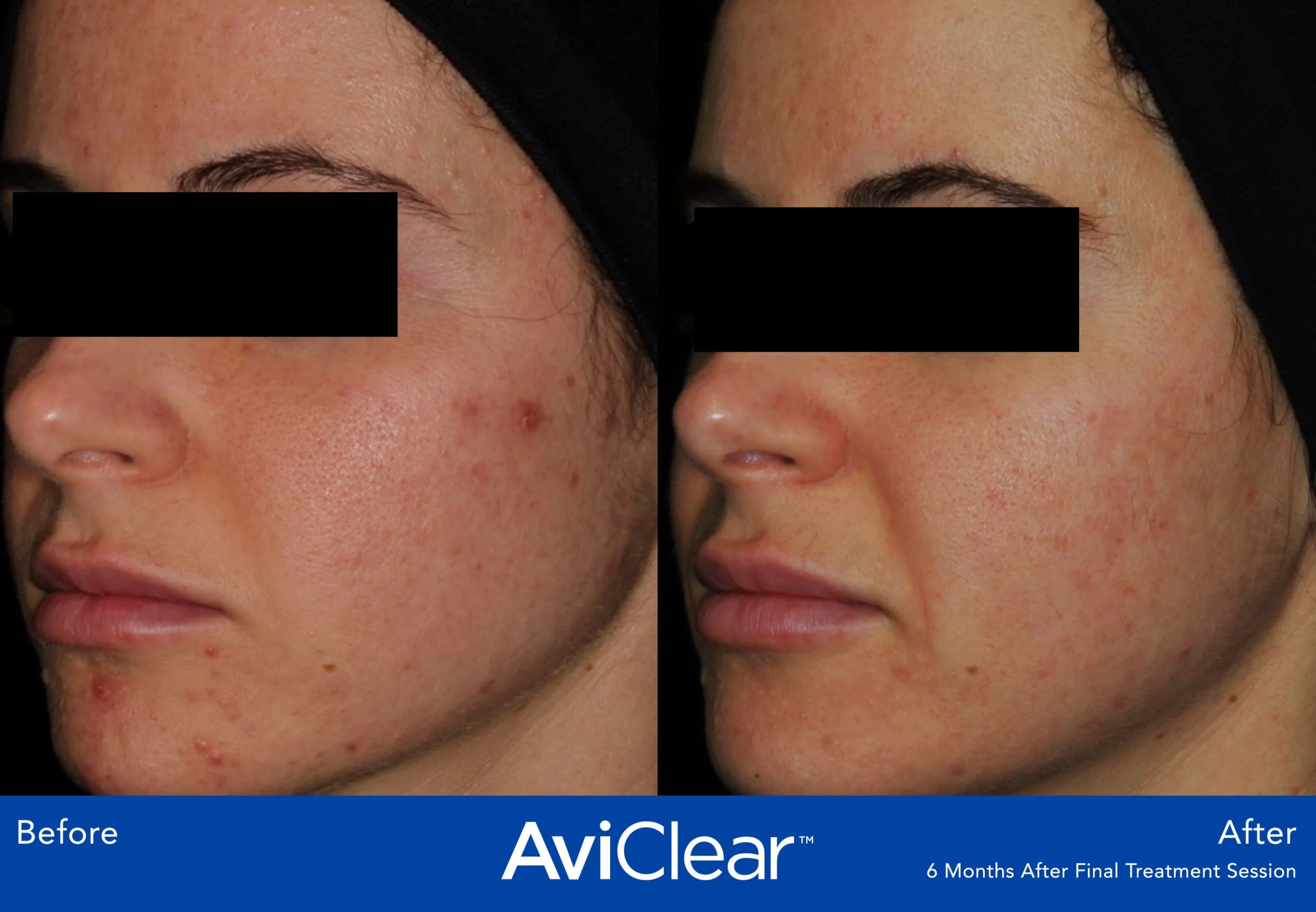 AviClear-Before-and-After-month-Live-Vibrant-Wellness-and-Aesthetics-in-Boynton-Beach-FL