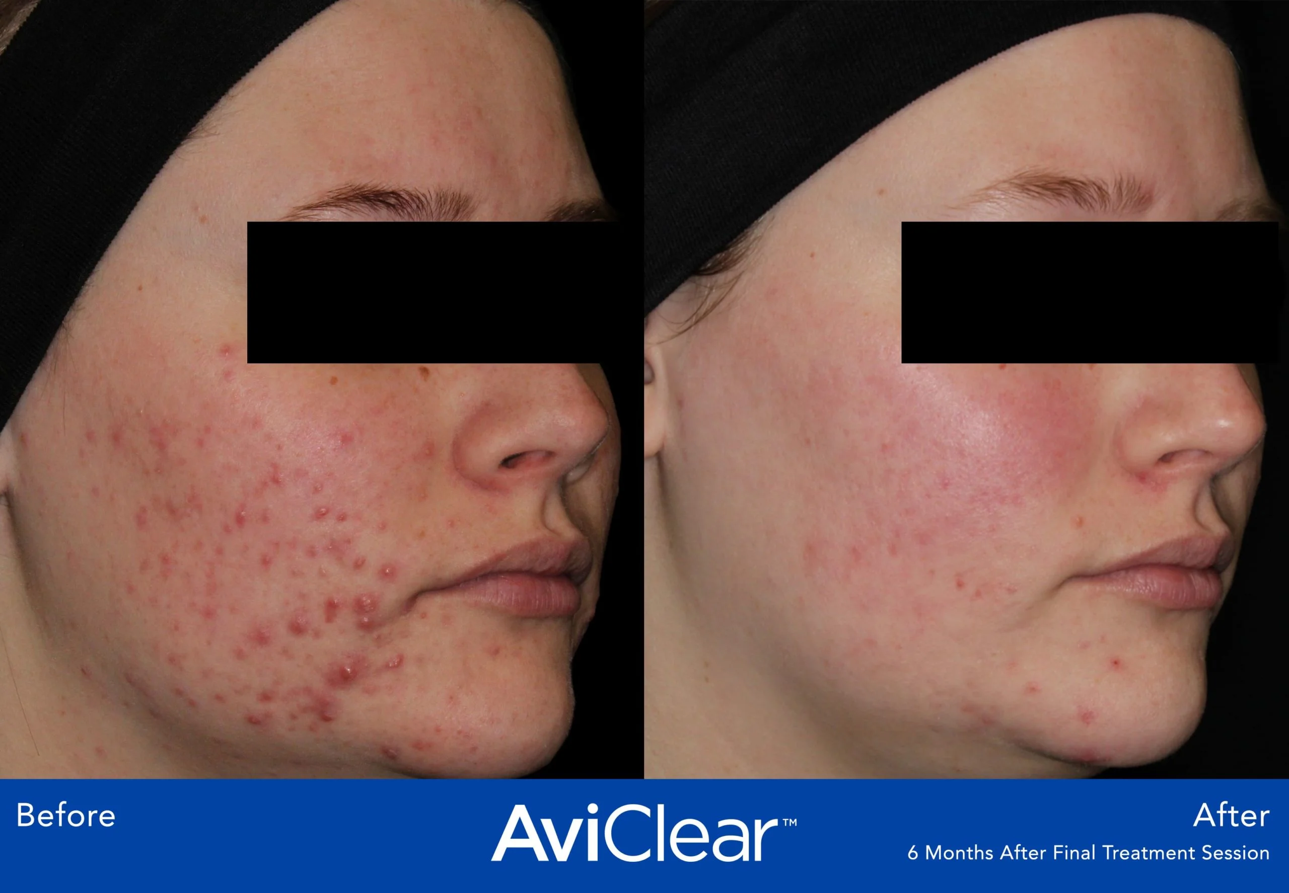 AviClear-Before-and-After-six-month-after-Live-Vibrant-Wellness-and-Aesthetics-in-Boynton-Beach-FL