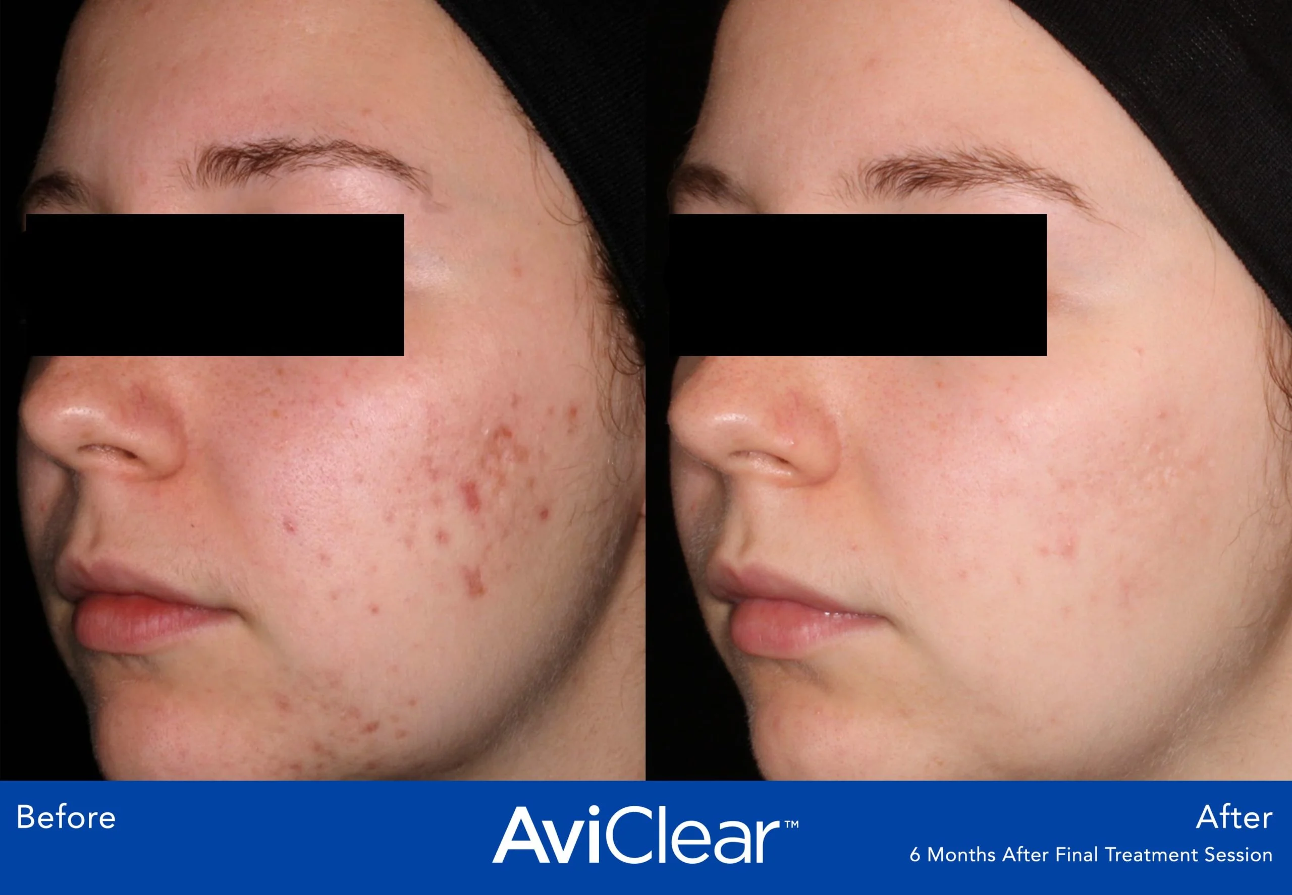 AviClear-Before-and-After-six-month-after-final-treatment-Live-Vibrant-Wellness-and-Aesthetics-in-Boynton-Beach-FL