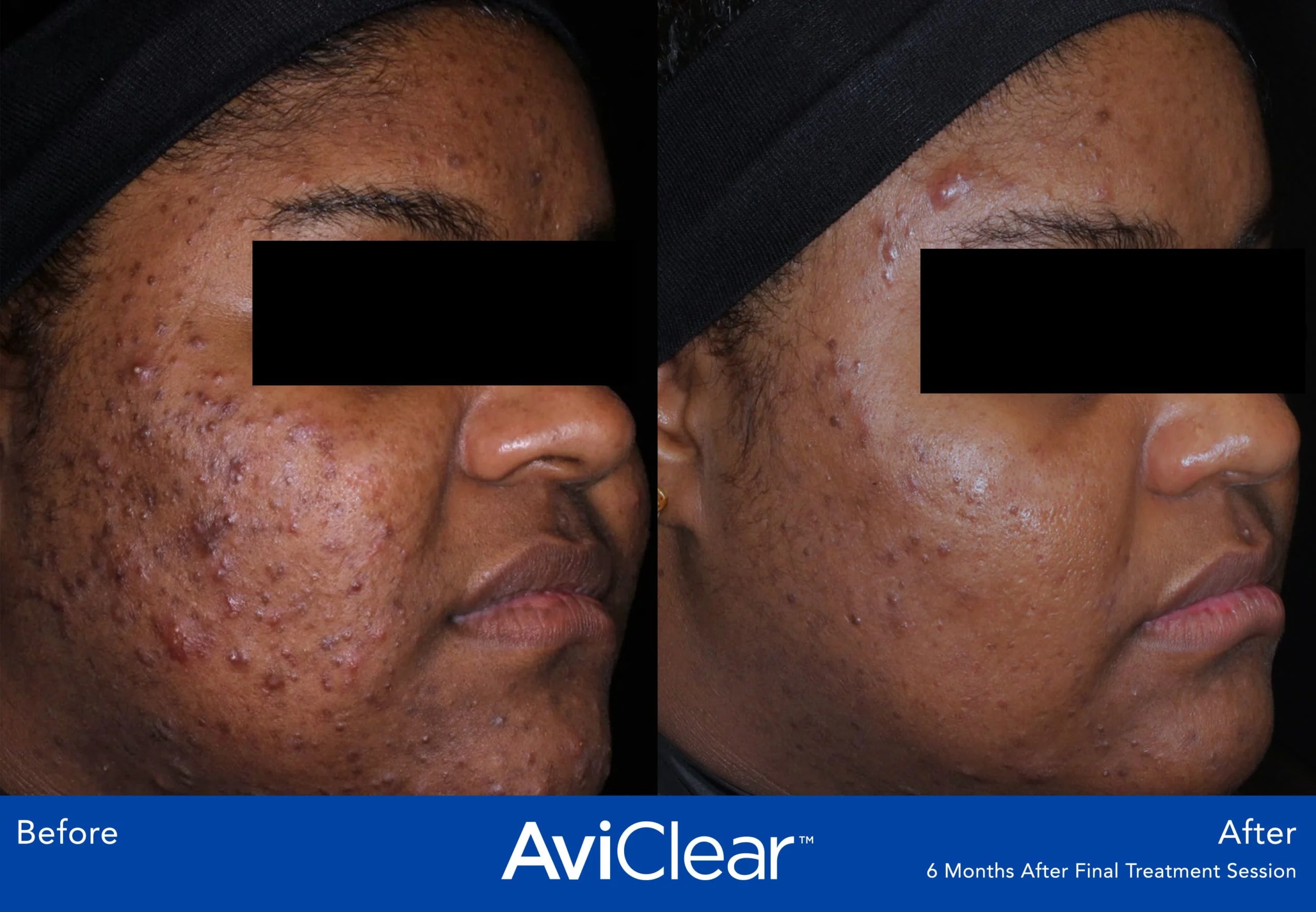 AviClear-Before-and-After-six-month-session-Live-Vibrant-Wellness-and-Aesthetics-in-Boynton-Beach-FL