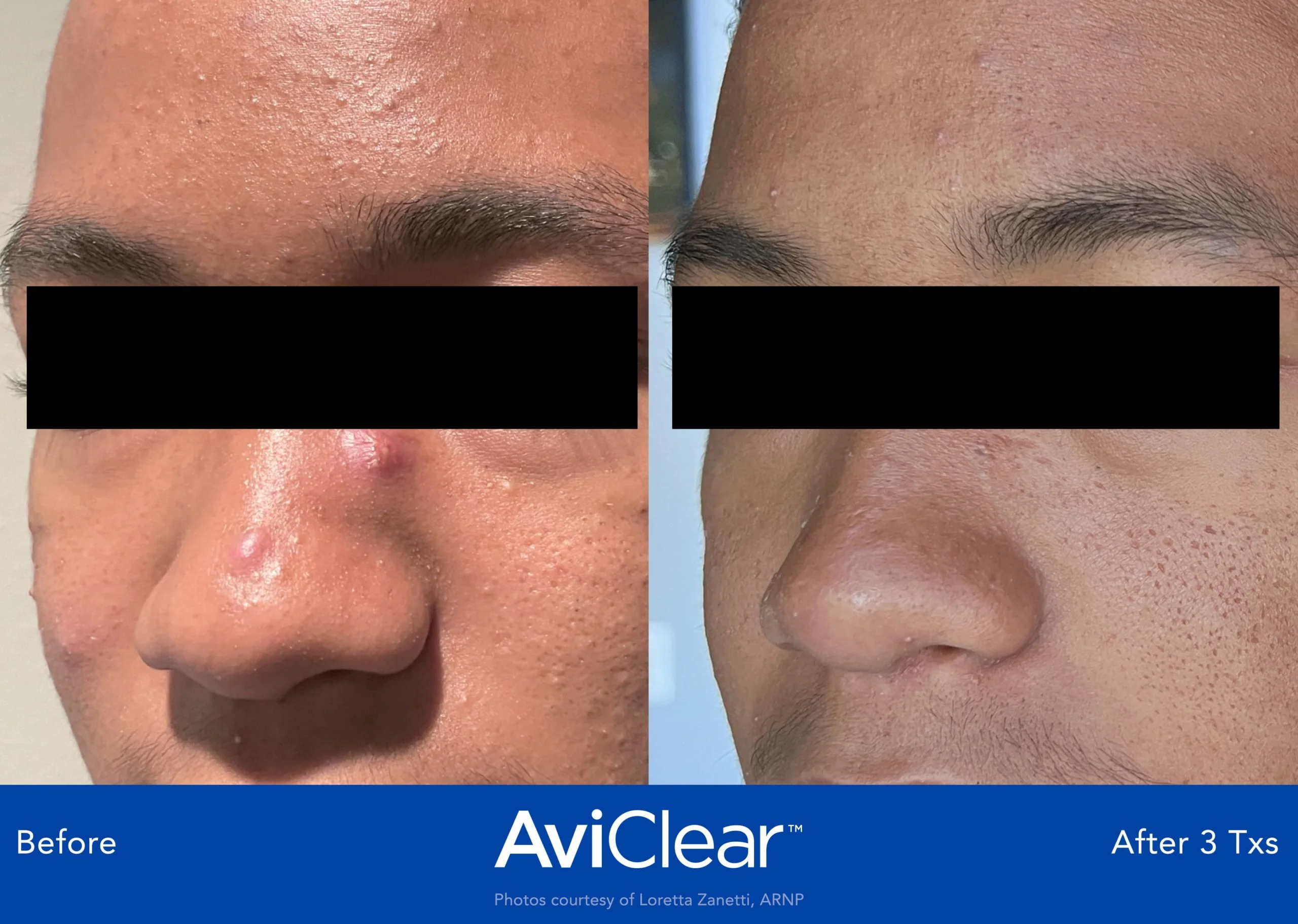 AviClear-Before-and-After-three-year-txs-Live-Vibrant-Wellness-and-Aesthetics-in-Boynton-Beach-FL