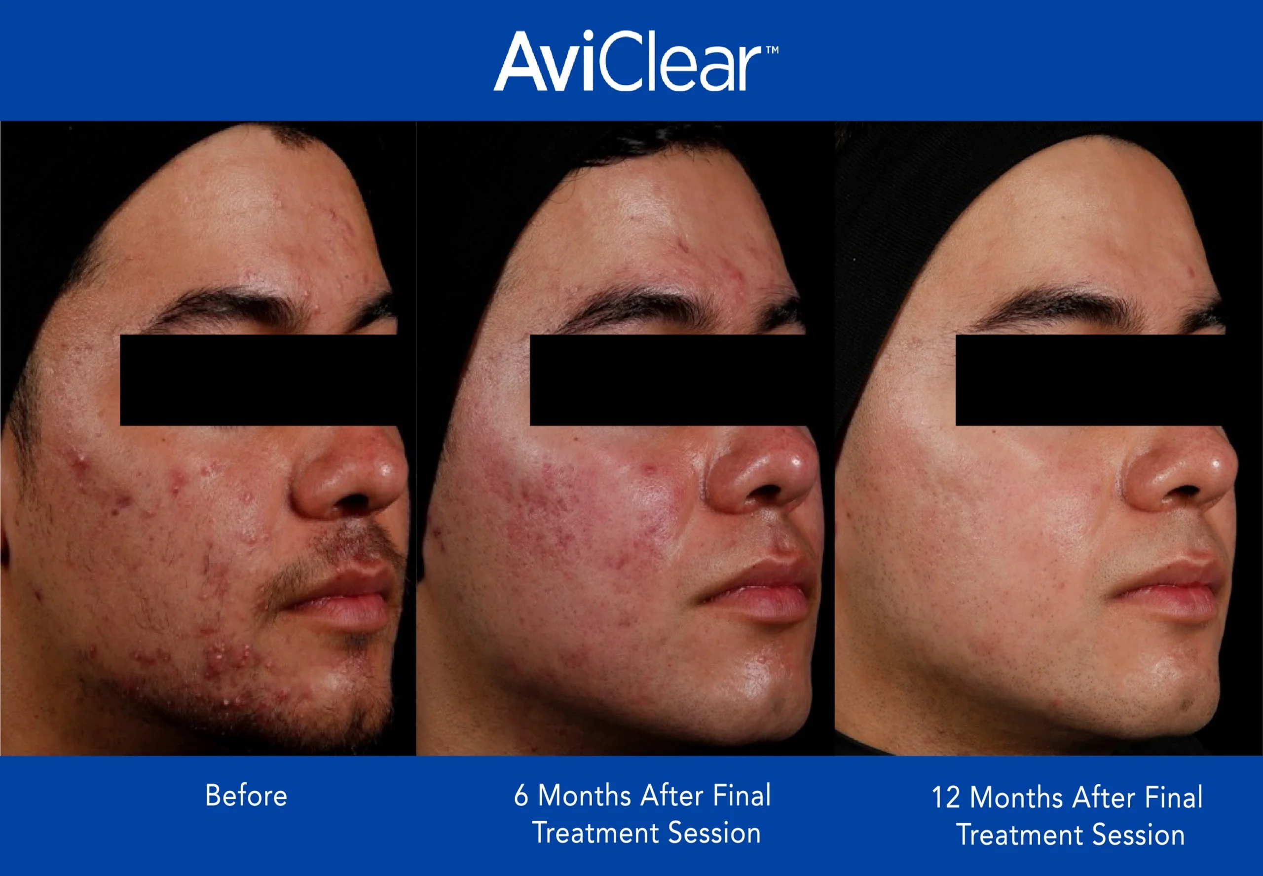 AviClear-Before-and-After-twelve-month-Live-Vibrant-Wellness-and-Aesthetics-in-Boynton-Beach-FL