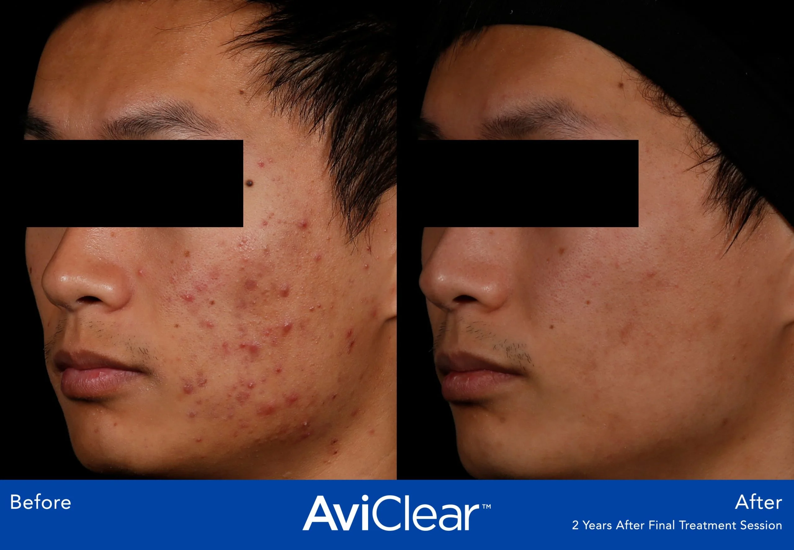 AviClear-Before-and-After-two-Live-Vibrant-Wellness-and-Aesthetics-in-Boynton-Beach-FL